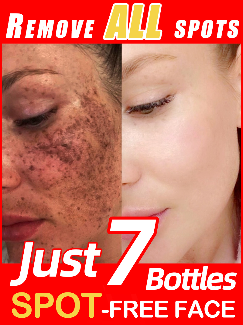 Luxury Skincare Essence - Verlicht sproeten Melasma, donkere gezichtsvlekken